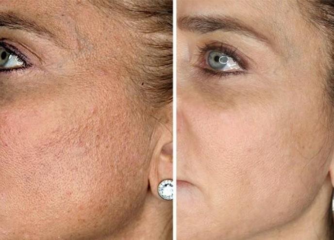Wrinkle reduction