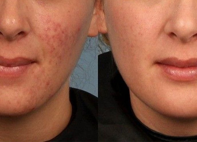 Acne clearing