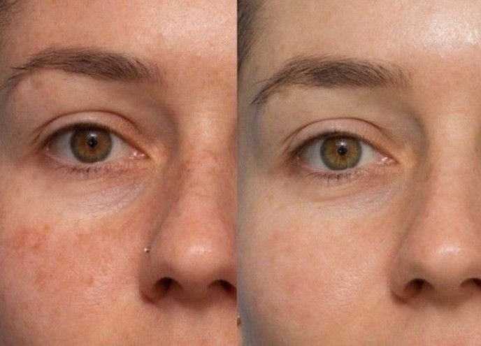 Pigmentation correction