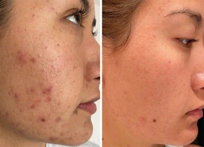 Skin rejuvenation