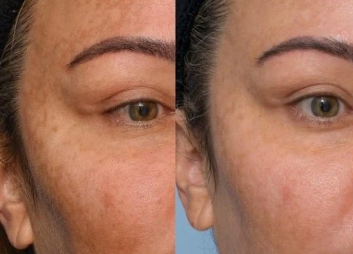 Refined skin structure